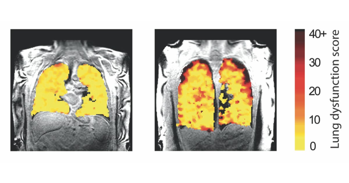 Two MRI lung scans side by side, showing a variation in measurements.