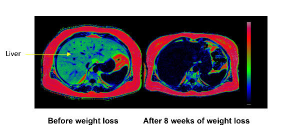 before-after-weight-loss-graphic