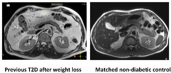 diagram-of-excess-liver-fat