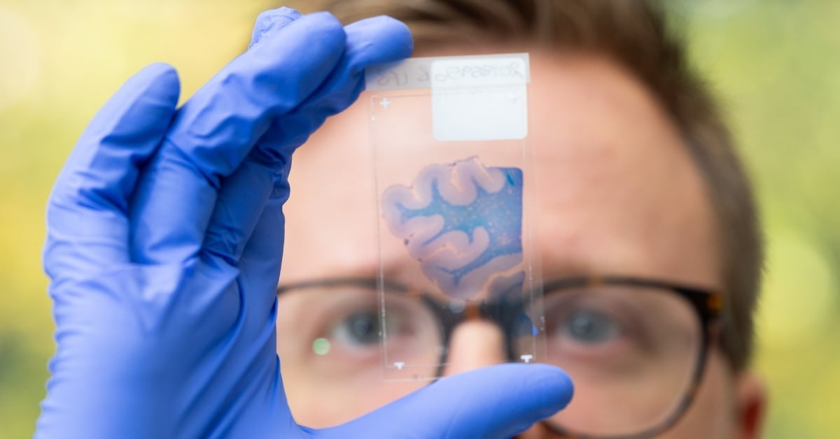 Dr Daniel Erskine examines brain tissue from a patient with DLB